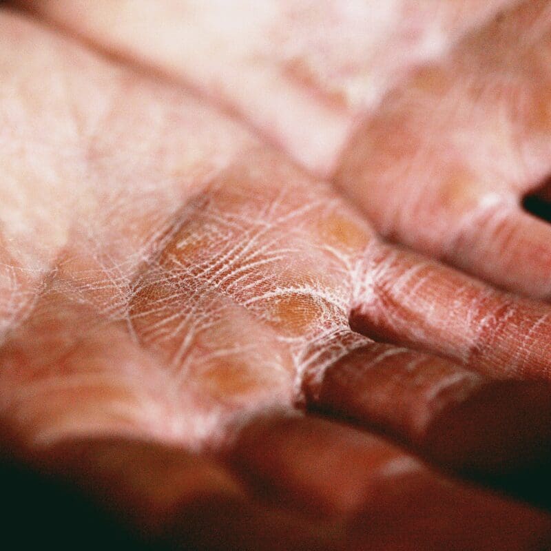 Dry skin on hands Dry skin on hands
