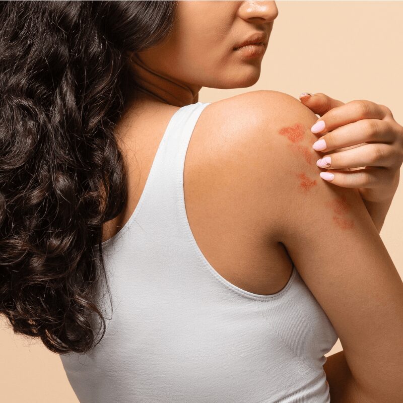 unhappy-young-woman-scratching-her-irritated-skin woman scratching at her dry, irritated skin