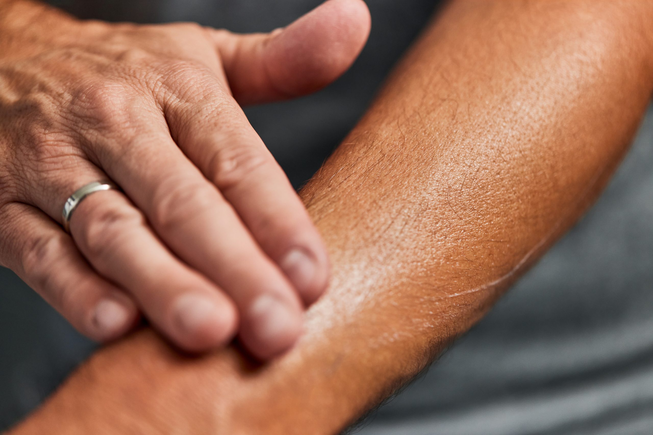 close up of man’s dry skin on his arm